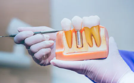 The Rise of Dental Implants as the Preferred Tooth Replacement Option