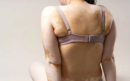 Does Vitiligo Treatment Help Restore Natural Pigment?