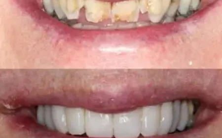 Can Composite Veneers Sydney Create a More Confident Smile? | Timeless Smiles Dental