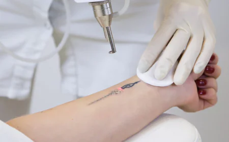Is Tattoo Removal a Good Option for Reducing Old Tattoos?