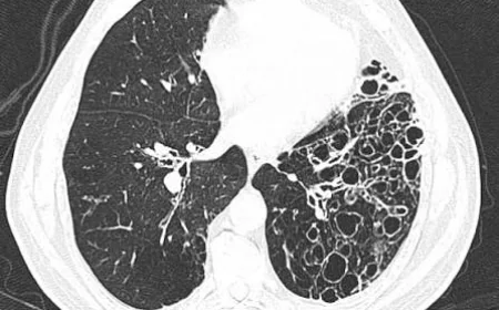 Primary Ciliary Dyskinesia Market Size, Trends, and Strategic Outlook 2026-2033