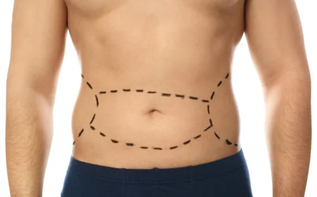 How Do You Prepare for Mini gastric bypass Surgery?