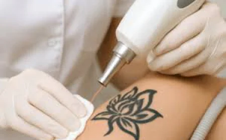 What factors affect Laser tattoo removal results?