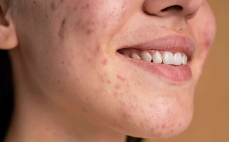 Why Does Acne Keep Coming Back Even After Treatment?