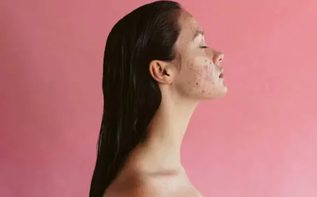 What Can Acne Treatment Do for Recurring Acne?