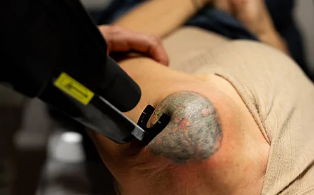 Can Laser Tattoo Removal target stubborn blue tattoo ink