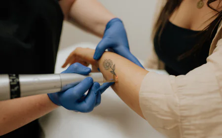 Is Laser Tattoo Removal Worth Considering for You?