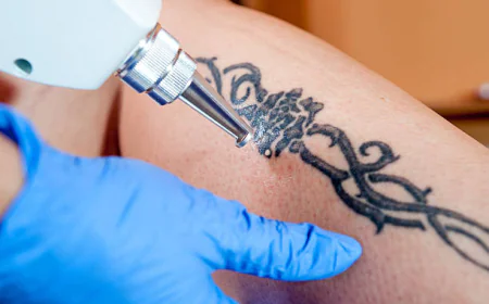 Is Laser Tattoo Removal Effective for Old Tattoos?