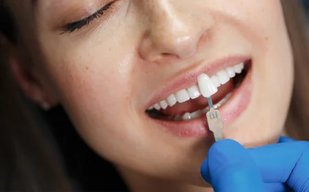 What Determines Veneers Cost