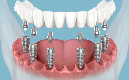 Investing in a Healthier Smile with Dental Implants in West Point, MS