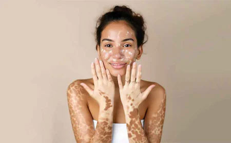 How Do You Prepare for Vitiligo Treatment