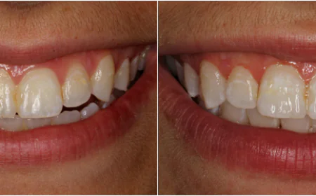 How Tooth-Colored Cavity Fillings Improve Smile Appearance