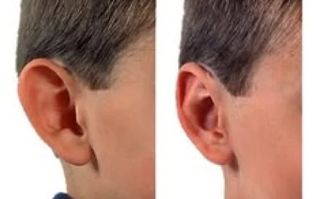 Ear Reshaping: Common Questions Answered