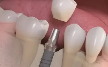 Dental Implants Dubai & Abu Dhabi for a Healthier-Looking Smile | Glamorous Clinic Dubai