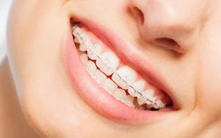Are Ceramic Braces Suitable for All Types of Teeth?