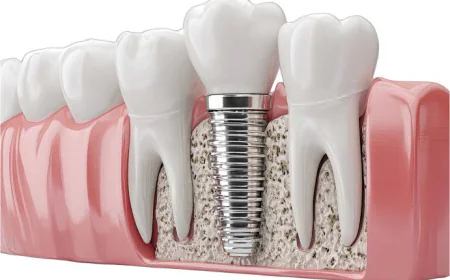 What to Know Before Choosing a Single Tooth Implant in Houston