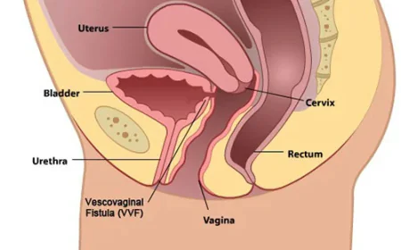 VVF Repair Surgery in Lucknow: Treatment, Procedure and Recovery