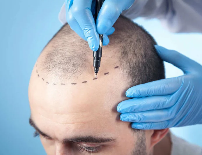 FUE Hair Transplant in Jeddah: Procedure and Benefits