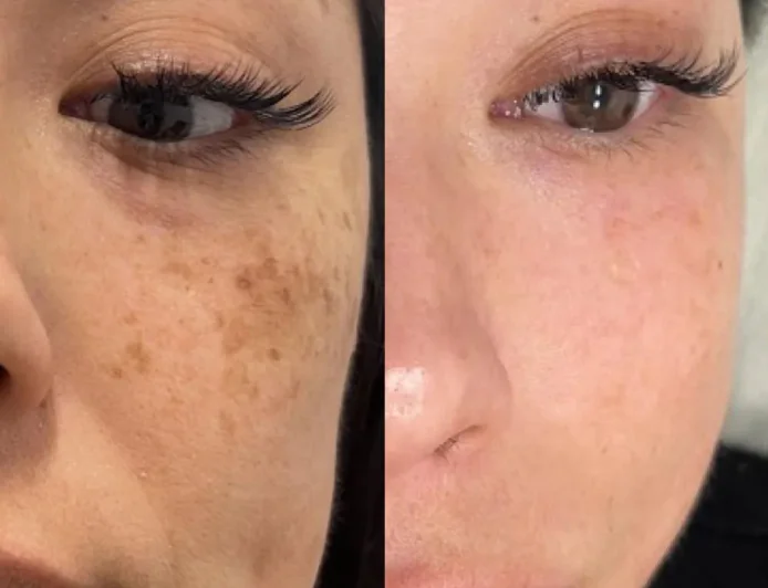 Best Skin Doctor in North East - Healthy, Glowing & Radiant Skin with Advanced Laser Treatments and Expert Dermatology Care | Essence Skin Care