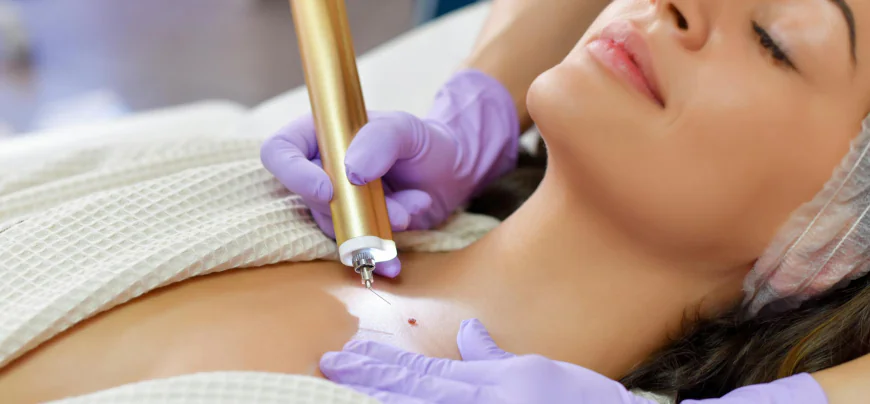 How Are Facial Moles Evaluated Before Removal?