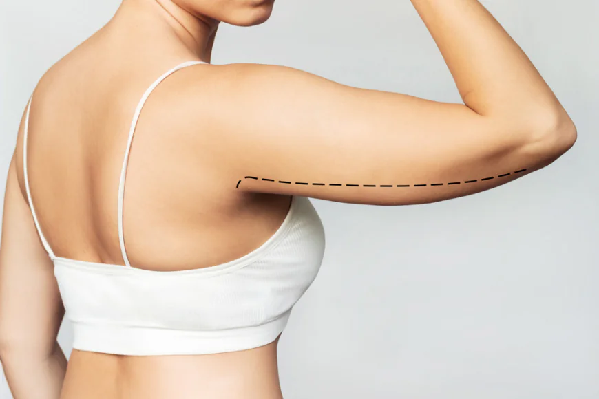 How Does Brachioplasty Differ for Mild and Severe Skin Laxity?