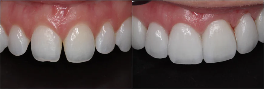 Affordable Veneers: How to Get a Great Smile on a Budget