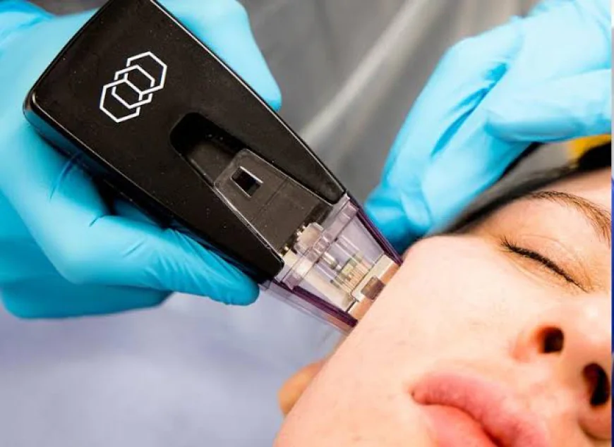 How Does Morpheus8 Improve Skin Texture and Tone?