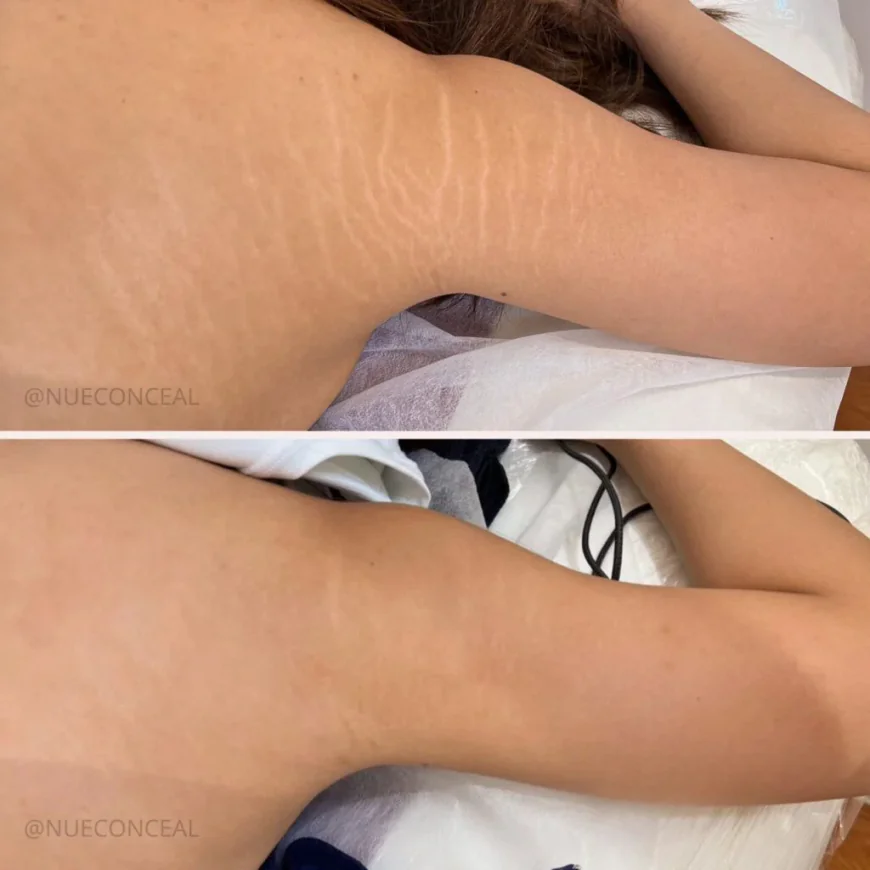 Stretch Mark Tattoo Cover Up for a More Even Skin Tone