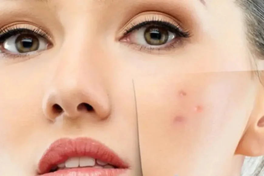 Is Laser Acne Scar treatment Good for Deep Scars