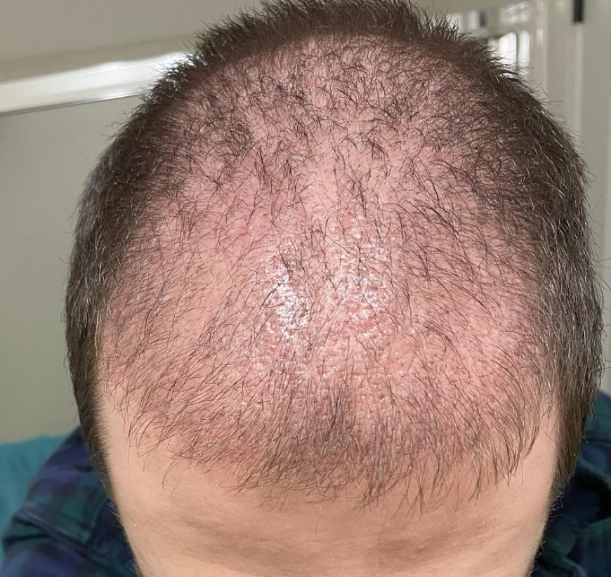 Does FUE Hair Transplant Boost New Hair Growth