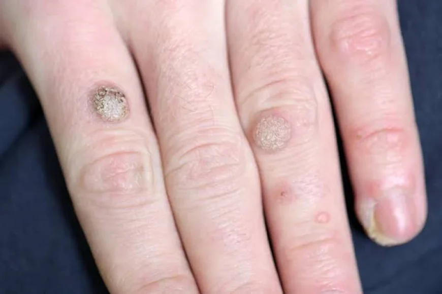 Can Wart Removal Permanently Eliminate Skin Warts?