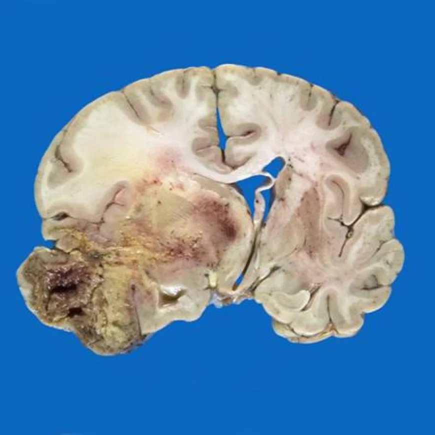 Glioblastoma Market: Size, Trends, and Strategic Outlook to 2033