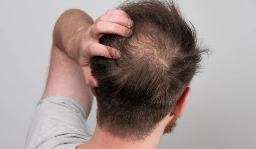 How Effective Is Scalp Micropigmentation?