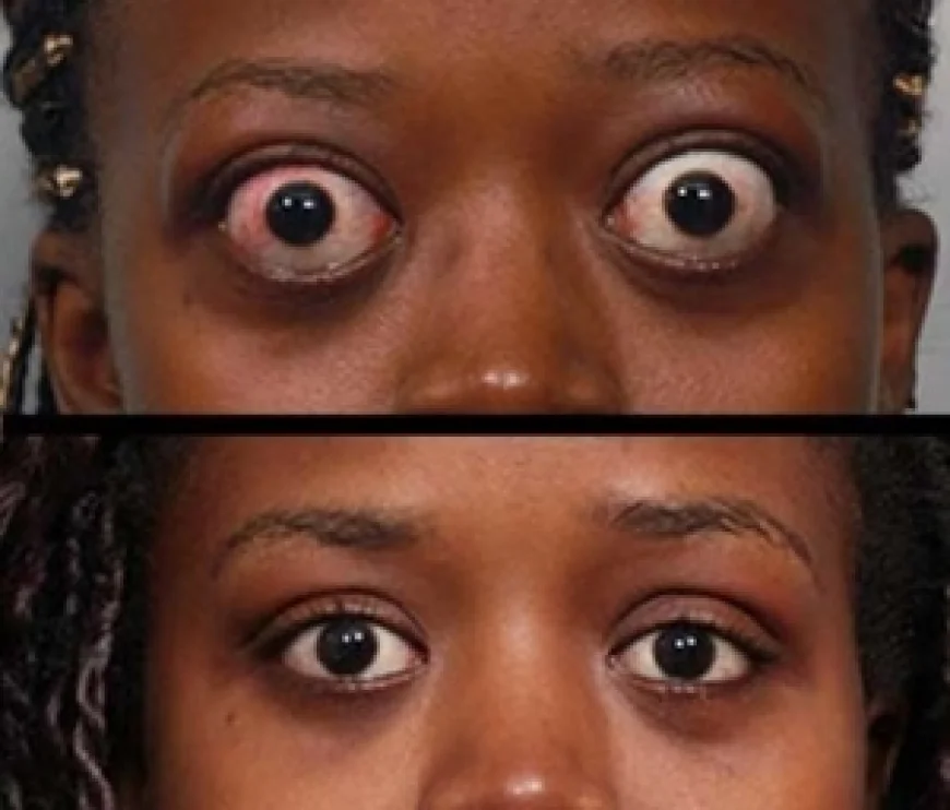 Thyroid Eye Disease Market Growth, Trends, and Strategic Insights from 2026 to 2033