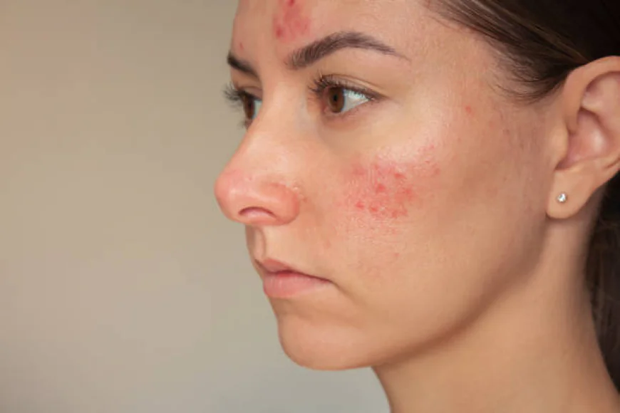 Can Laser Acne Scar Treatment Target Uneven Texture?