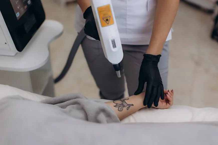 Does Laser Tattoo Removal work on colored tattoos