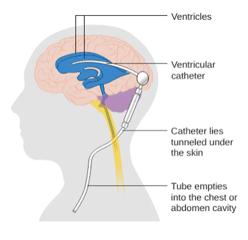 Hydrocephalus Shunts Market Size, Growth, and Strategic Insights 2026-2033