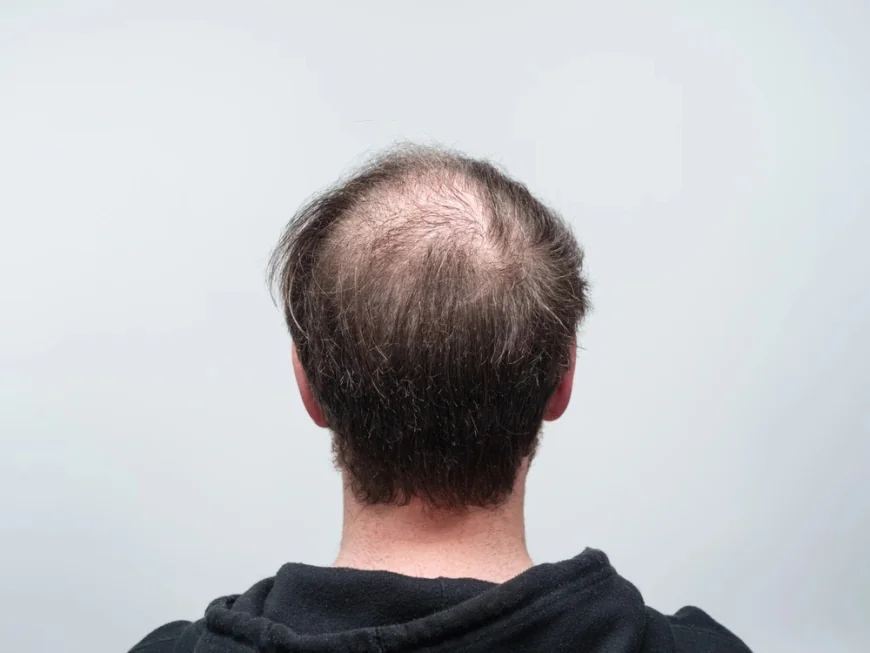 How Successful Is Crown Hair Transplant for Baldness?