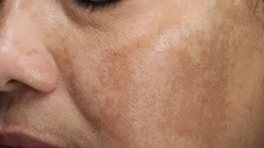 Can Melasma Treatment Help With Hormonal Dark Patches