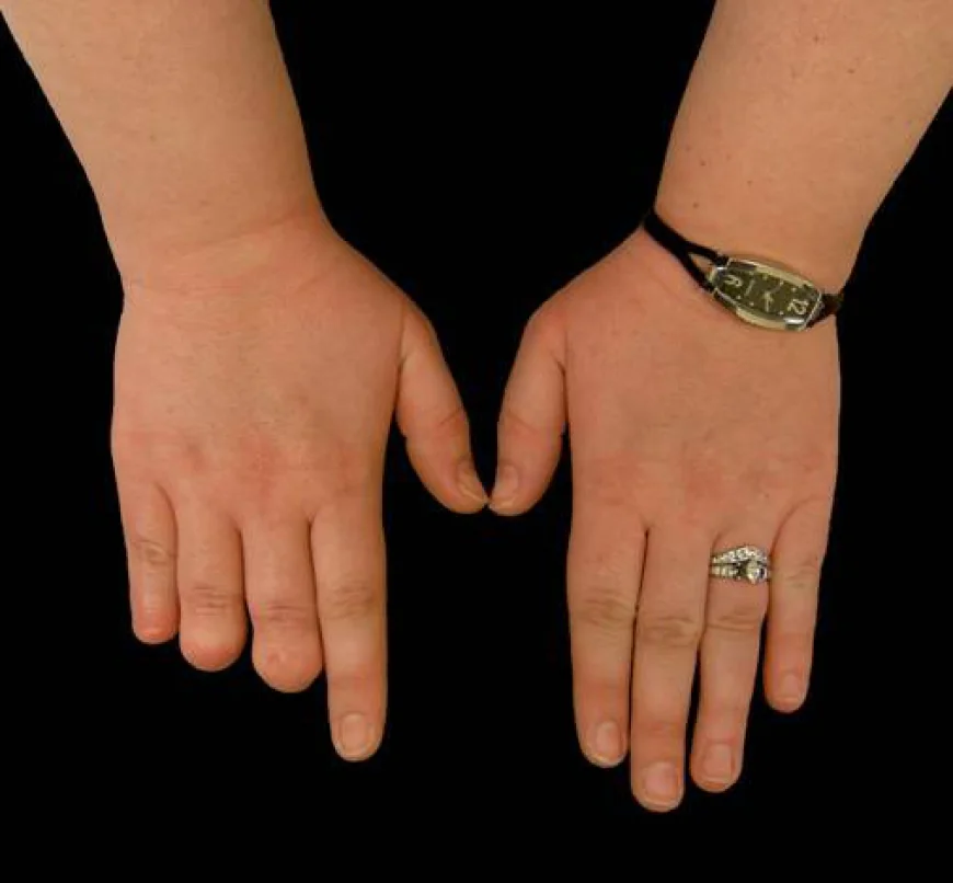 Finger Prosthetics for Every Lifestyle: Matching the Right Device to What You Actually Do