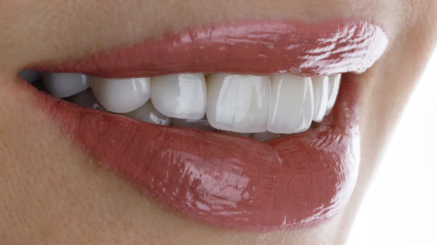 What to Expect From Dental Veneers