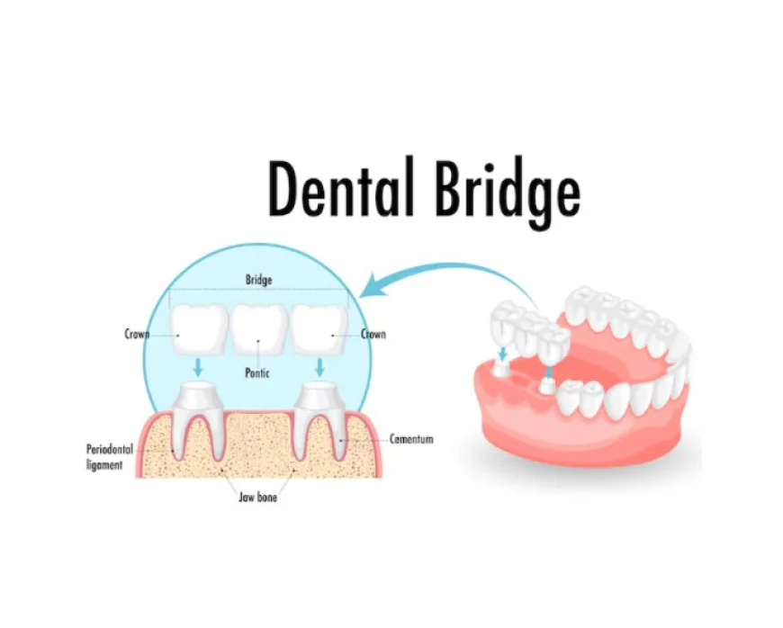 Porcelain Teeth Bridge: Uses, Benefits, and Care Tips