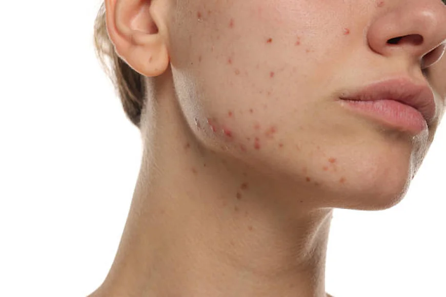 Is Acne Treatment safe for long-term acne management