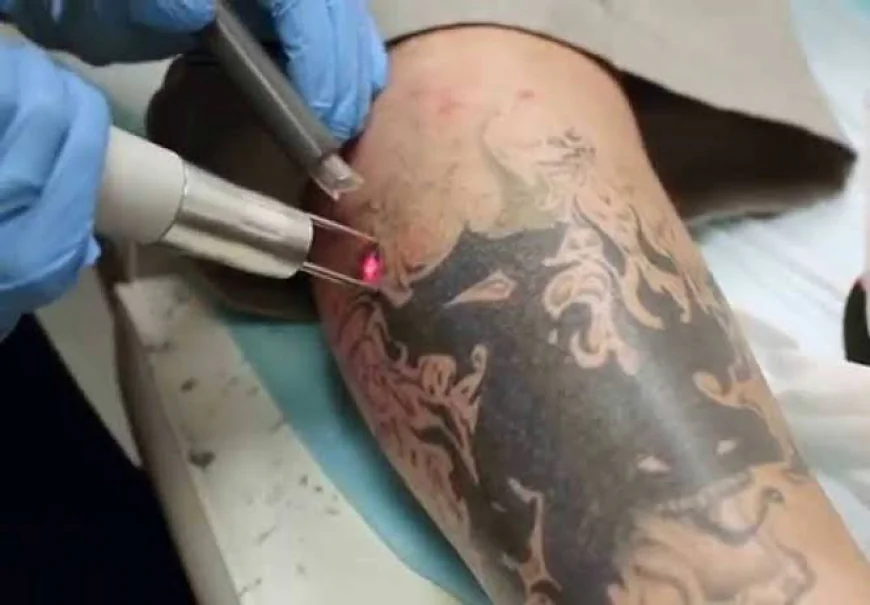 What should you know before choosing Laser tattoo removal?