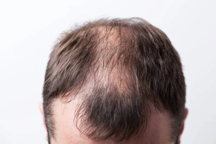 Can Hair Loss Treatment complement PRP hair therapy