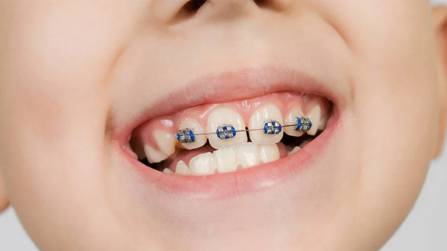Dental Braces: Your Guide to Orthodontic Care