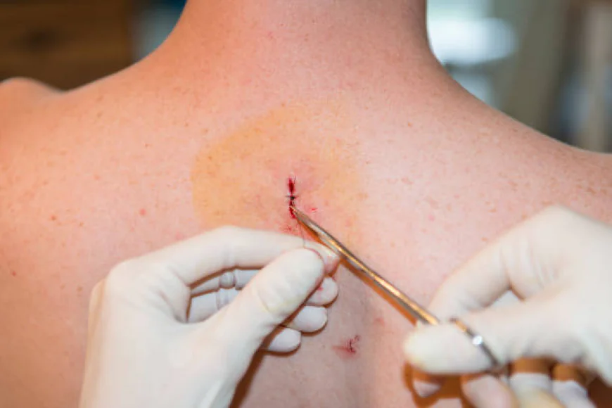 How Does Skin Lesion Removal Improve Skin Appearance Today?