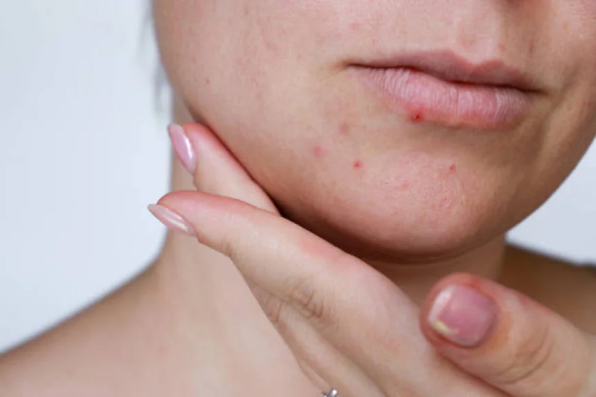 How Can Acne Treatment Support Clearer-Looking Skin?