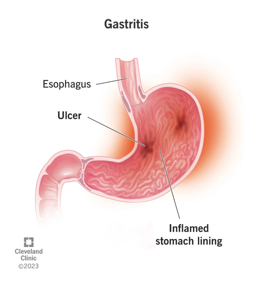 Evolving Dynamics in the Gastritis Treatment Market: Size, Growth, and Strategic Outlook
