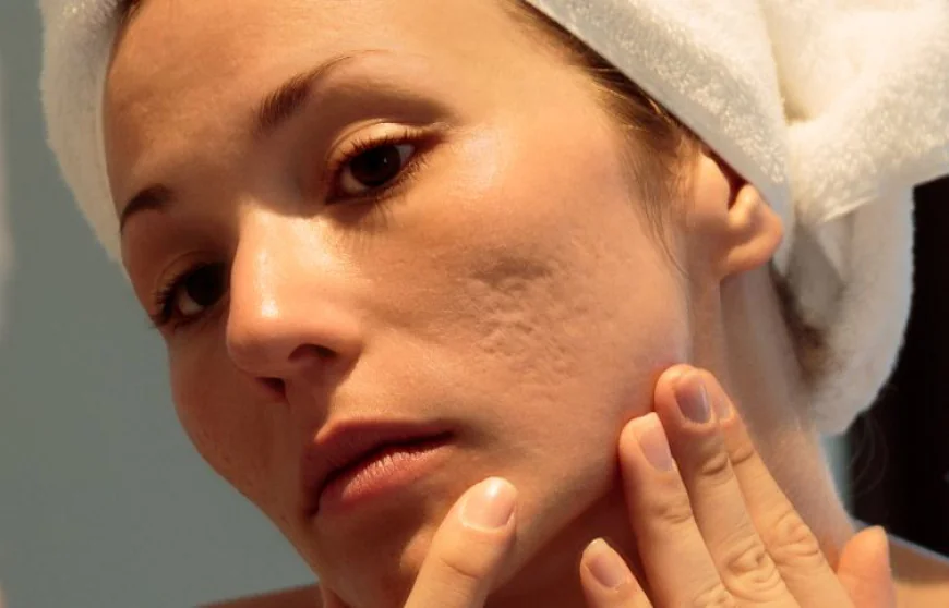 Is Acne Scar Treatment Right for Facial Texture Concerns?